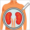 Common Kidney Questions